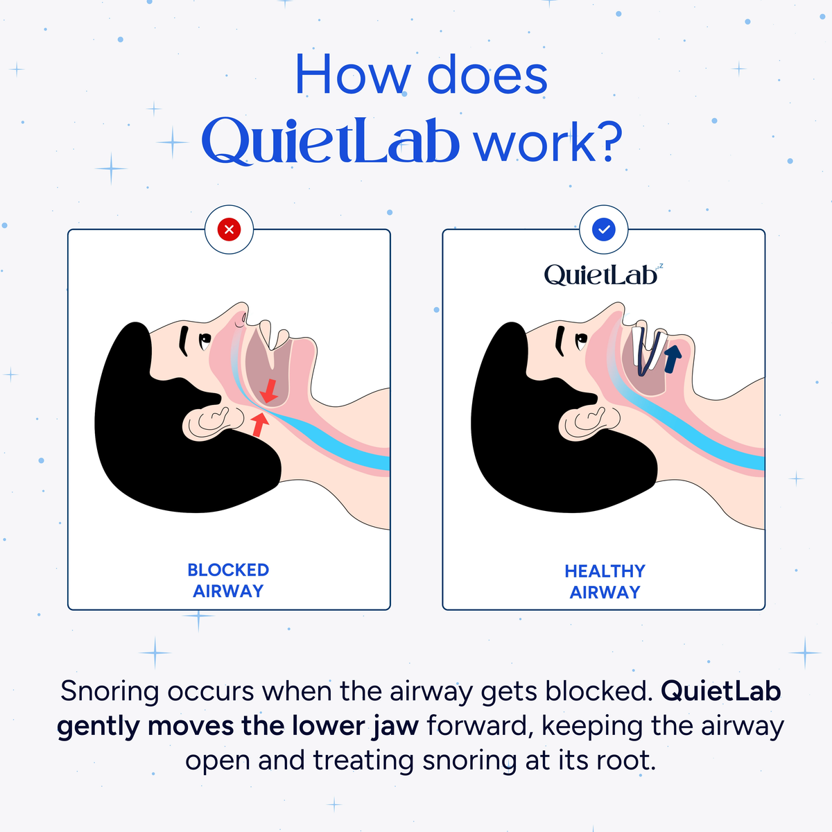 Adjustable Anti-Snoring Mouthpiece
